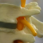 What is a Herniated Disc