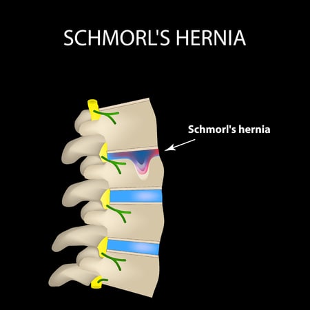 herniated cervical disc