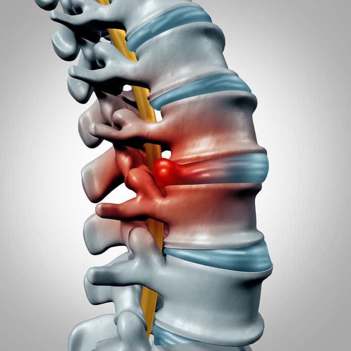 Herniated Cervical Discs